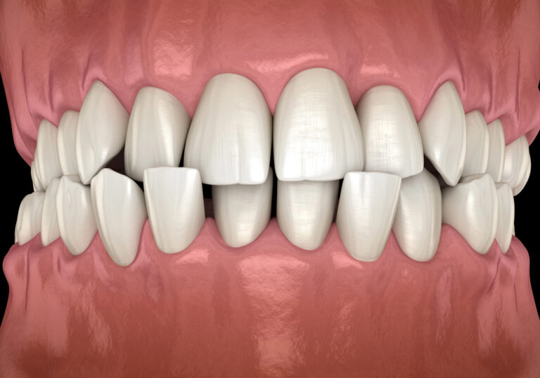 A 3D illustration of a mouth with a crossbite.