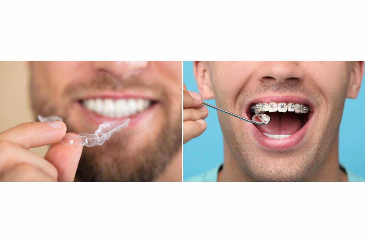 A side-by-side comparison of two orthodontic treatments: on the left, a man holding a clear aligner in front of his smiling mouth; on the right, a close-up of another man with metal braces, mouth open as a dental mirror inspects his teeth.